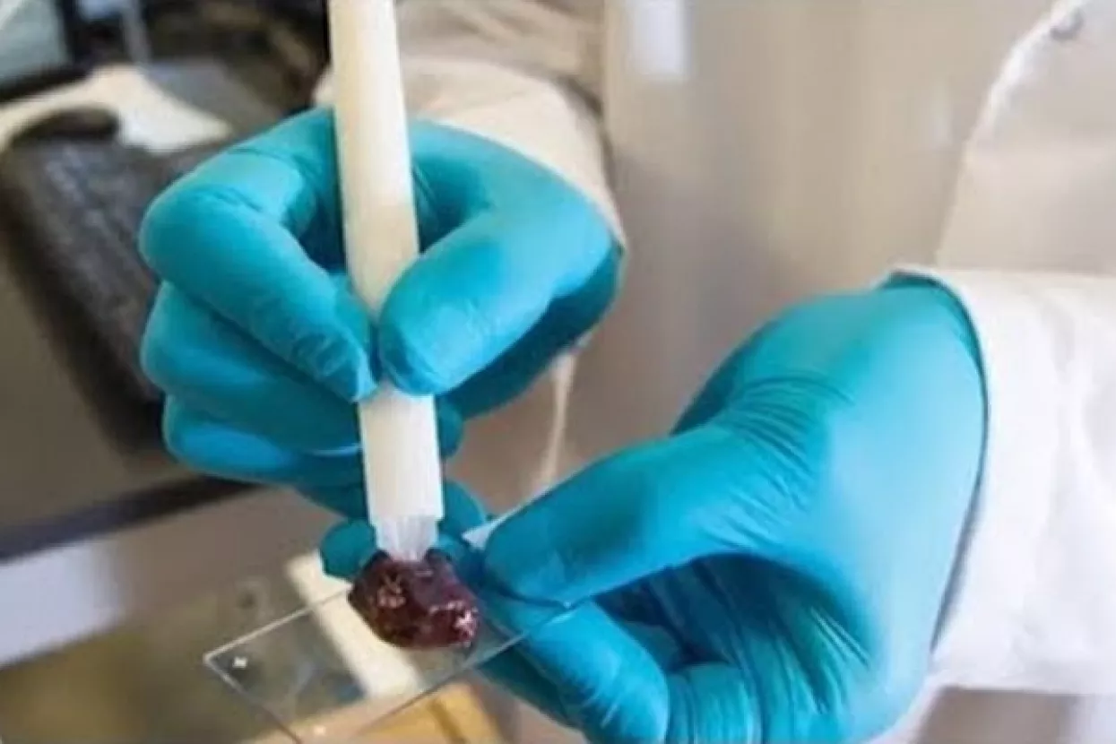 Nova MassSpec Pen sonda u 10 sekundi otkriva kancerogene stanice